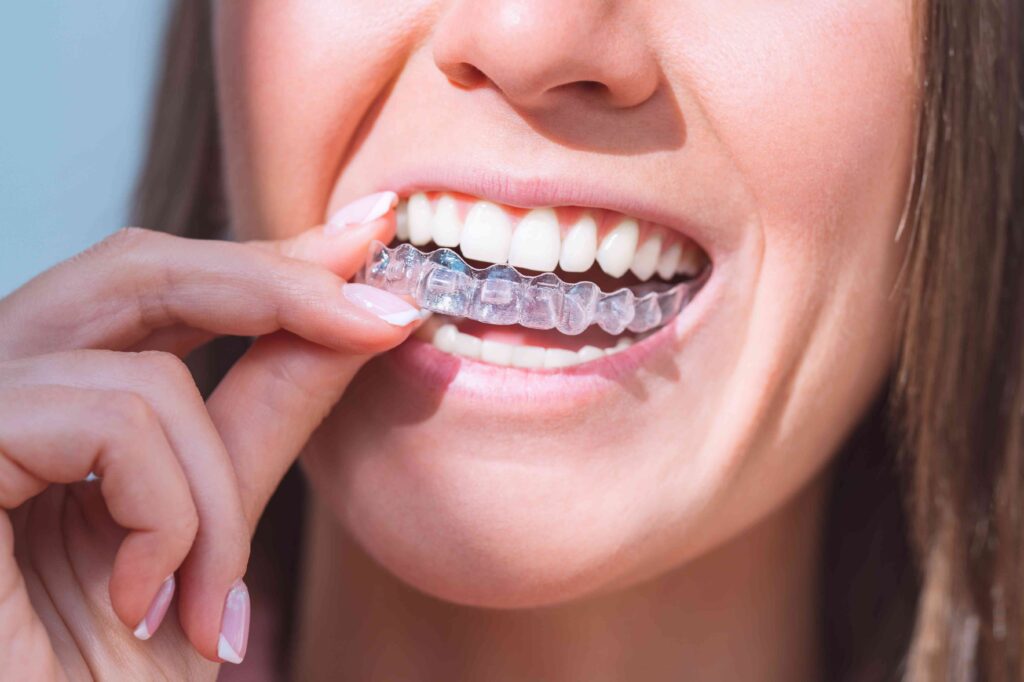 Woman putting in a retainer